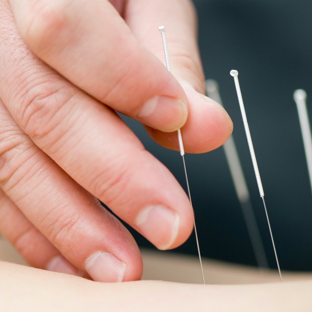 A close up of a hand placing acupuncture pins on someone