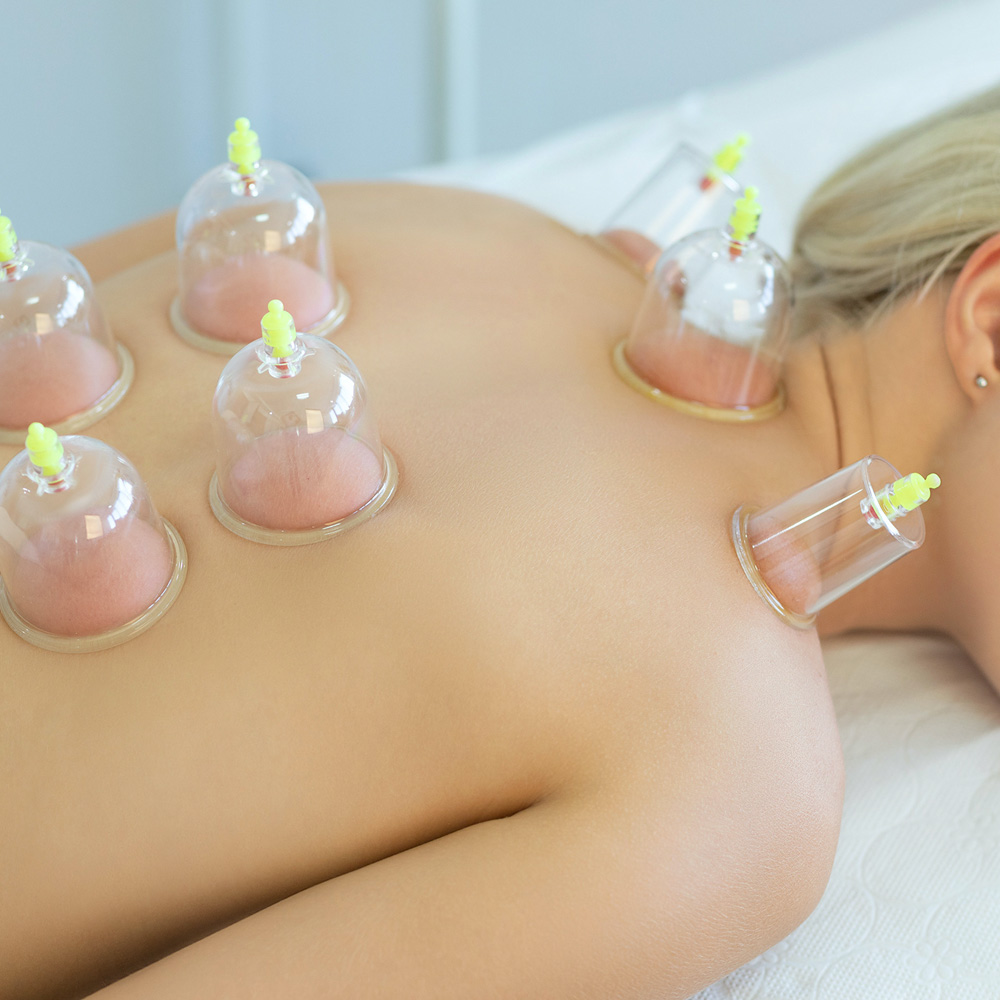 A patient with seven seven glass cups placed on her back.