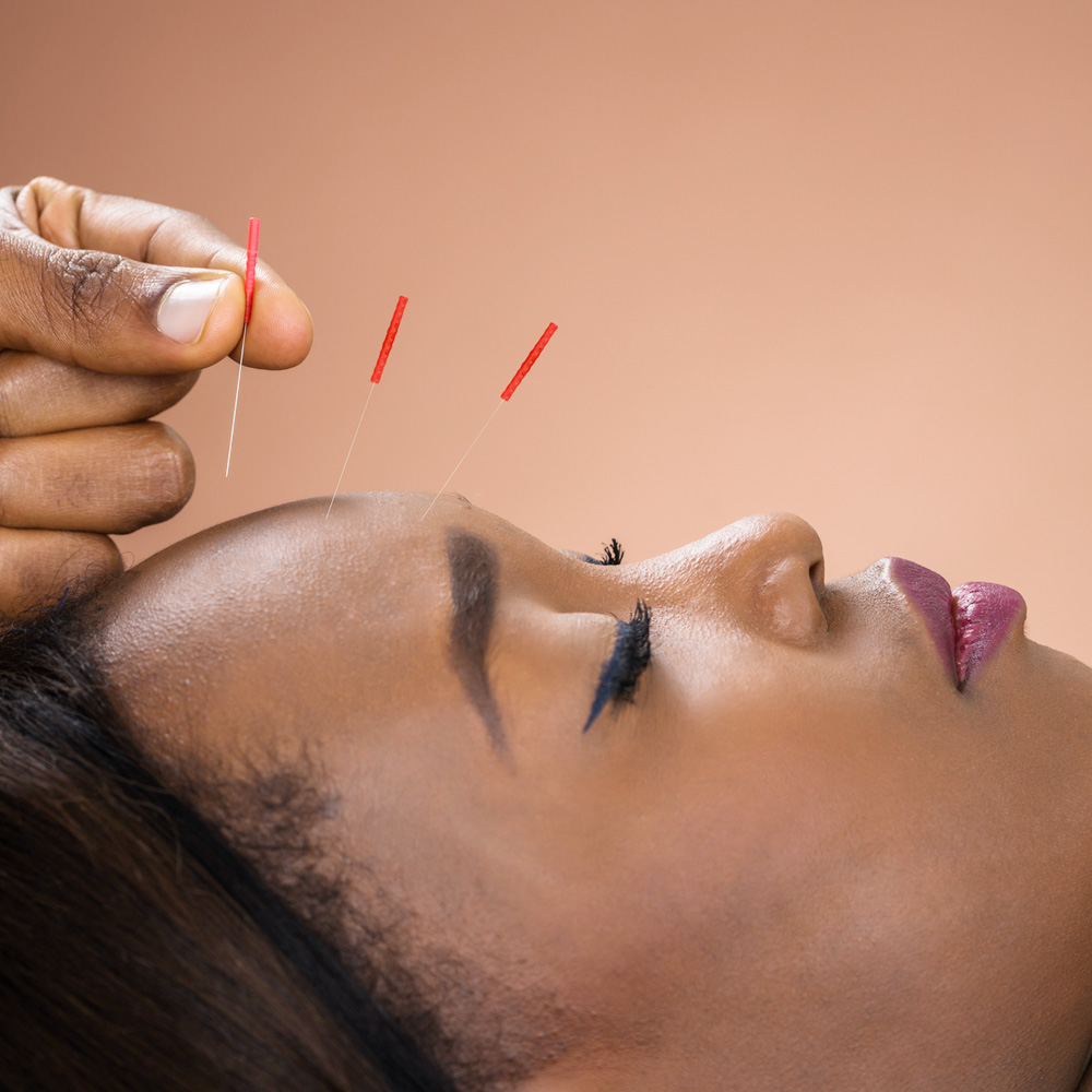 Three needles being placed in the forehead of a patient