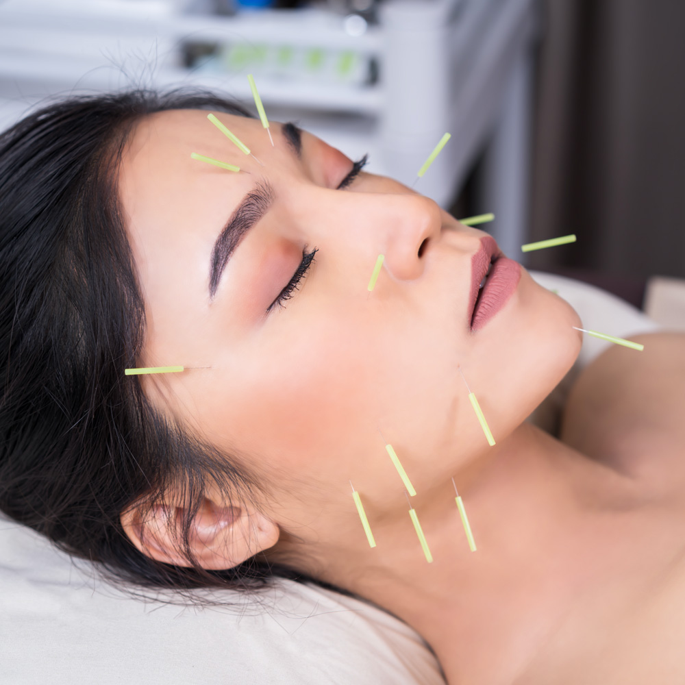 A woman with several acupuncture needles placed throughout her face.