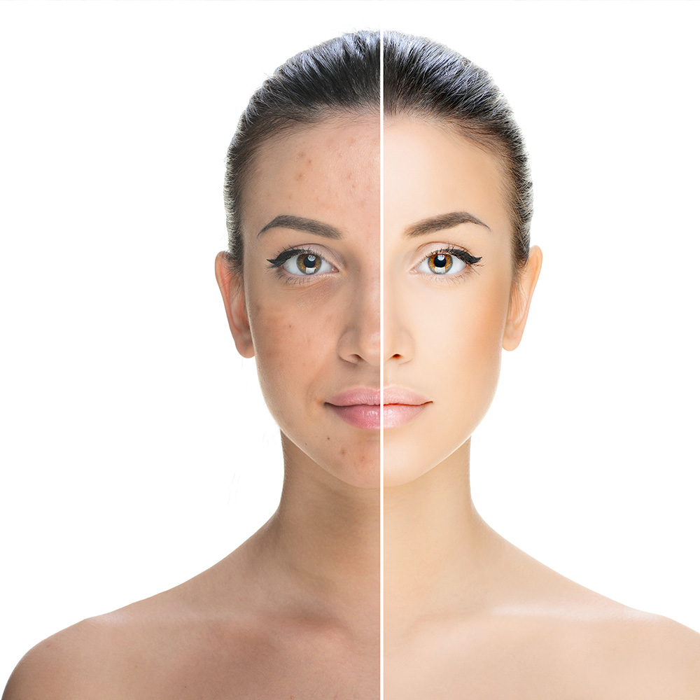 A portrait of a woman with her face divided to show her skin before acupuncture therapy and after.