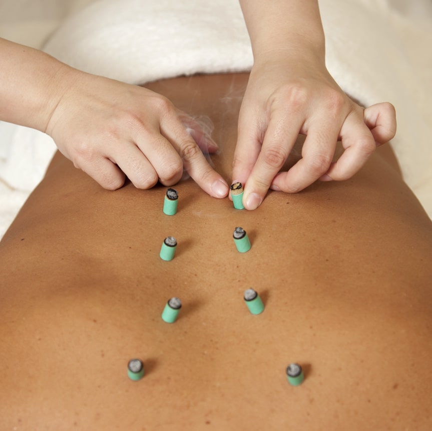 A Refuge practitioner placing several moxibustion bundles on the back of a patient.