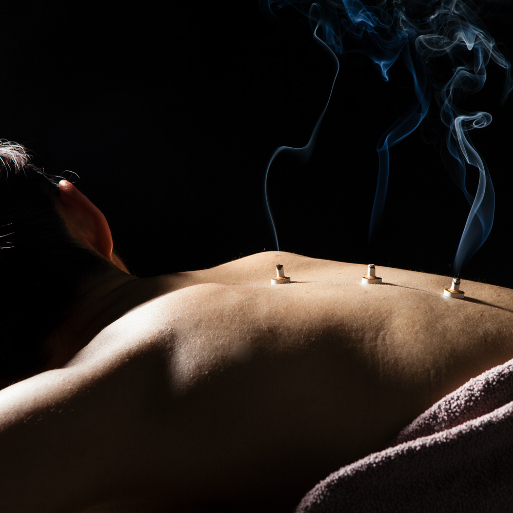 A patient receiving treatment at the Denver Refuge office, with three moxibustion bundles placed along their spine.